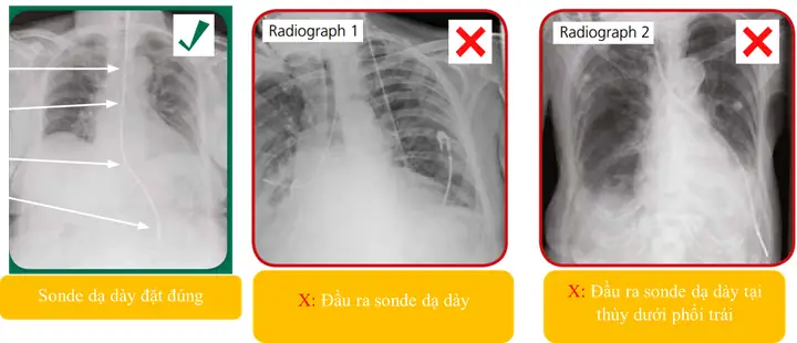 Thức ăn hỗn hợp cho đường sonde dạ dày: Hướng dẫn chi tiết Thức ăn hỗn hợp cho đường sonde dạ dày: Hướng dẫn chi tiết