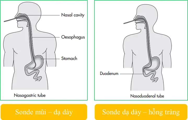 Thức ăn hỗn hợp cho đường sonde dạ dày: Hướng dẫn chi tiết