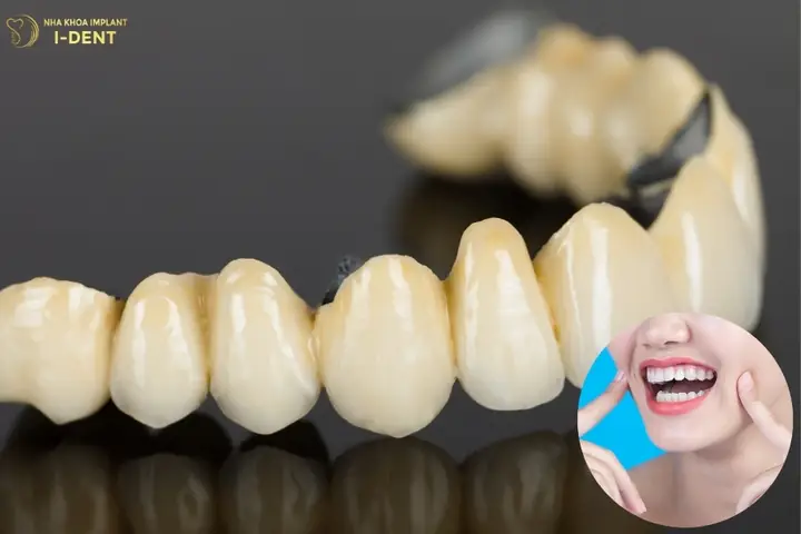 Giá Răng Sứ Kim Loại