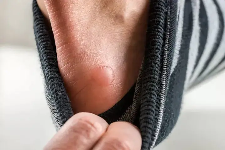 Cách Chữa Phồng Rộp Chân Vì Giày Chật Nhanh Chóng Và Phòng Ngừa Hiệu Quả Cách Chữa Phồng Rộp Chân Vì Giày Chật Nhanh Chóng Và Phòng Ngừa Hiệu Quả