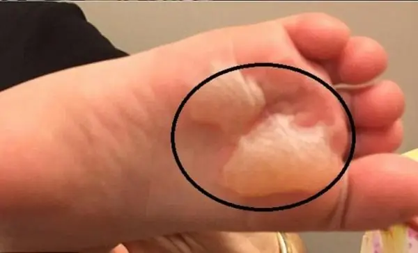 Cách Chữa Phồng Rộp Chân Vì Giày Chật Nhanh Chóng Và Phòng Ngừa Hiệu Quả Cách Chữa Phồng Rộp Chân Vì Giày Chật Nhanh Chóng Và Phòng Ngừa Hiệu Quả