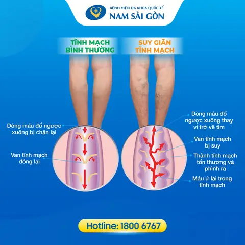 Suy giãn tĩnh mạch chân là gì? Suy giãn tĩnh mạch chân là gì?