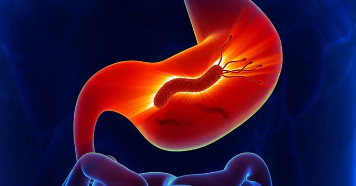 Những Dấu Hiệu Và Triệu Chứng Của Bệnh Nhiễm H.pylori Là Gì?
