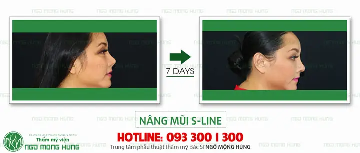 Tìm Hiểu Thực Hư Về Độ Hiệu Quả Và An Tòa Của Phương Pháp Nâng Mũi Bằng Chỉ Webtretho