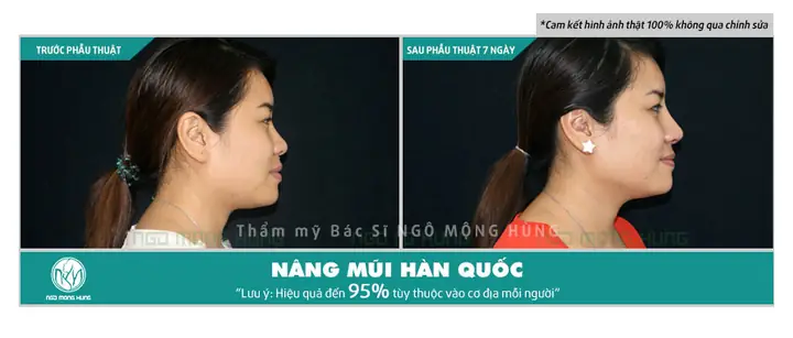Tìm Hiểu Thực Hư Về Độ Hiệu Quả Và An Tòa Của Phương Pháp Nâng Mũi Bằng Chỉ Webtretho