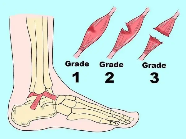 2/ Triệu Chứng Lật Sơ Mi Cổ Chân Trong Đá Bóng