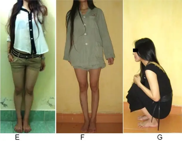 Một số điều cần biết về kéo dài chân, nâng chiều cao