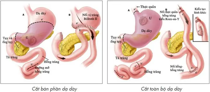 Cắt Dạ Dày Là Gì? Cắt Dạ Dày Là Gì?